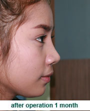 plastic_surgery_augmentation_rhinoplasty